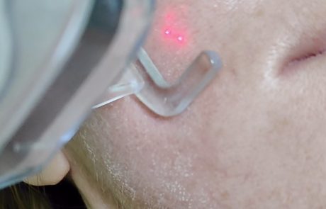 fractional laser co2