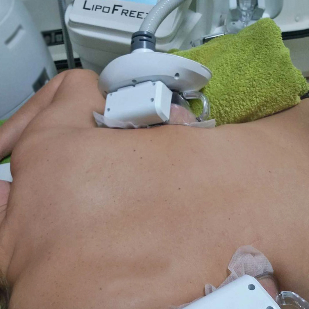 lipoFreeze cryolipolisis paphos eliana louka