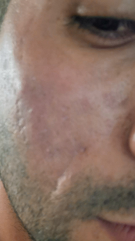 after fractional laser co2 treatment for acne scars