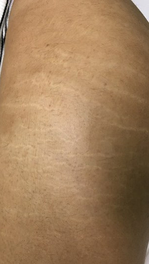 after-fractional-laser-co2-stretch-marks