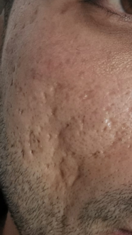 before fractional laser co2 treatment for acne scars