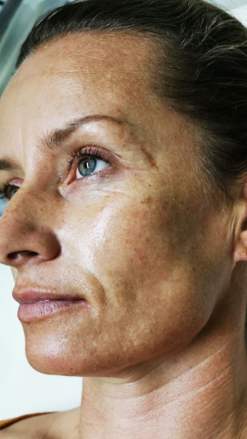 fractional laer co2 pigmentation-panades before paphos